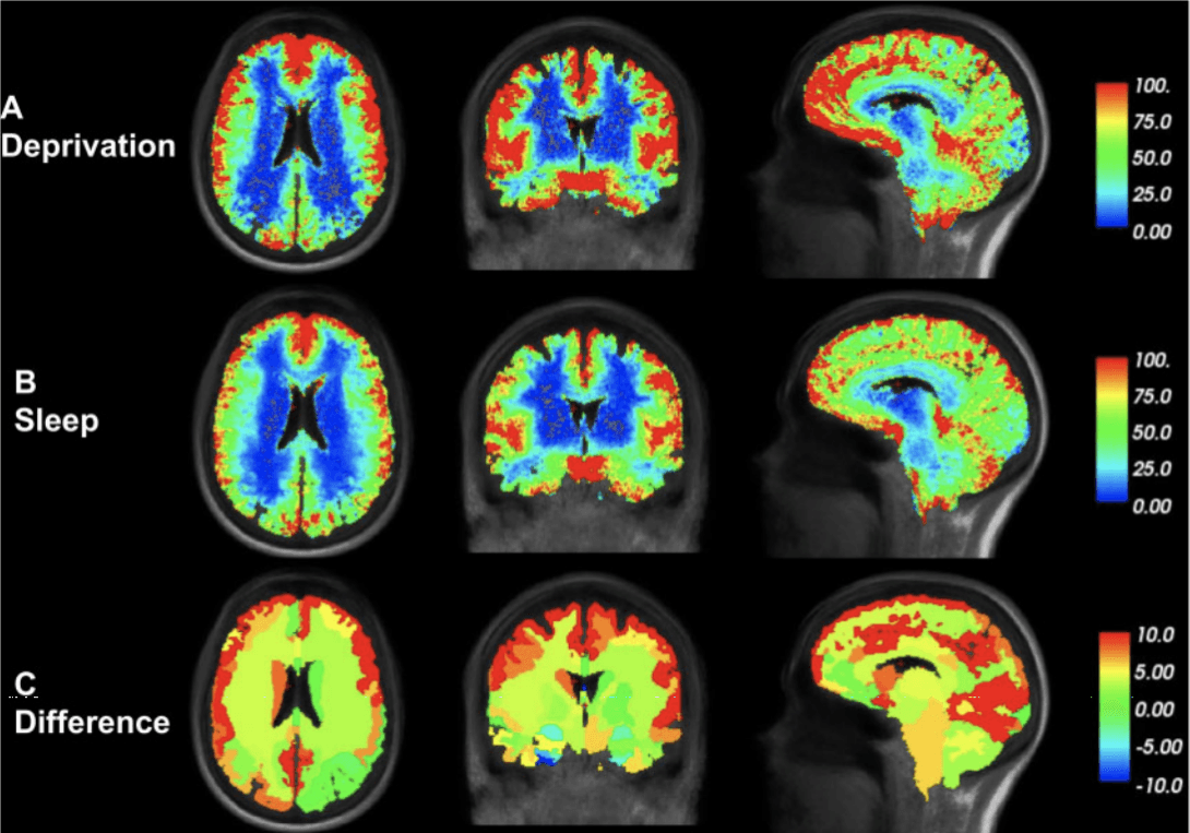 How lack of sleep affects your brain